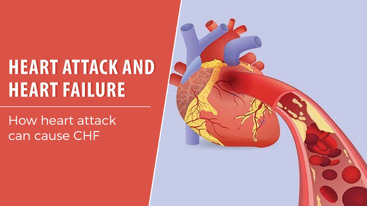 Heart Attack and Heart Failure (Spanish)