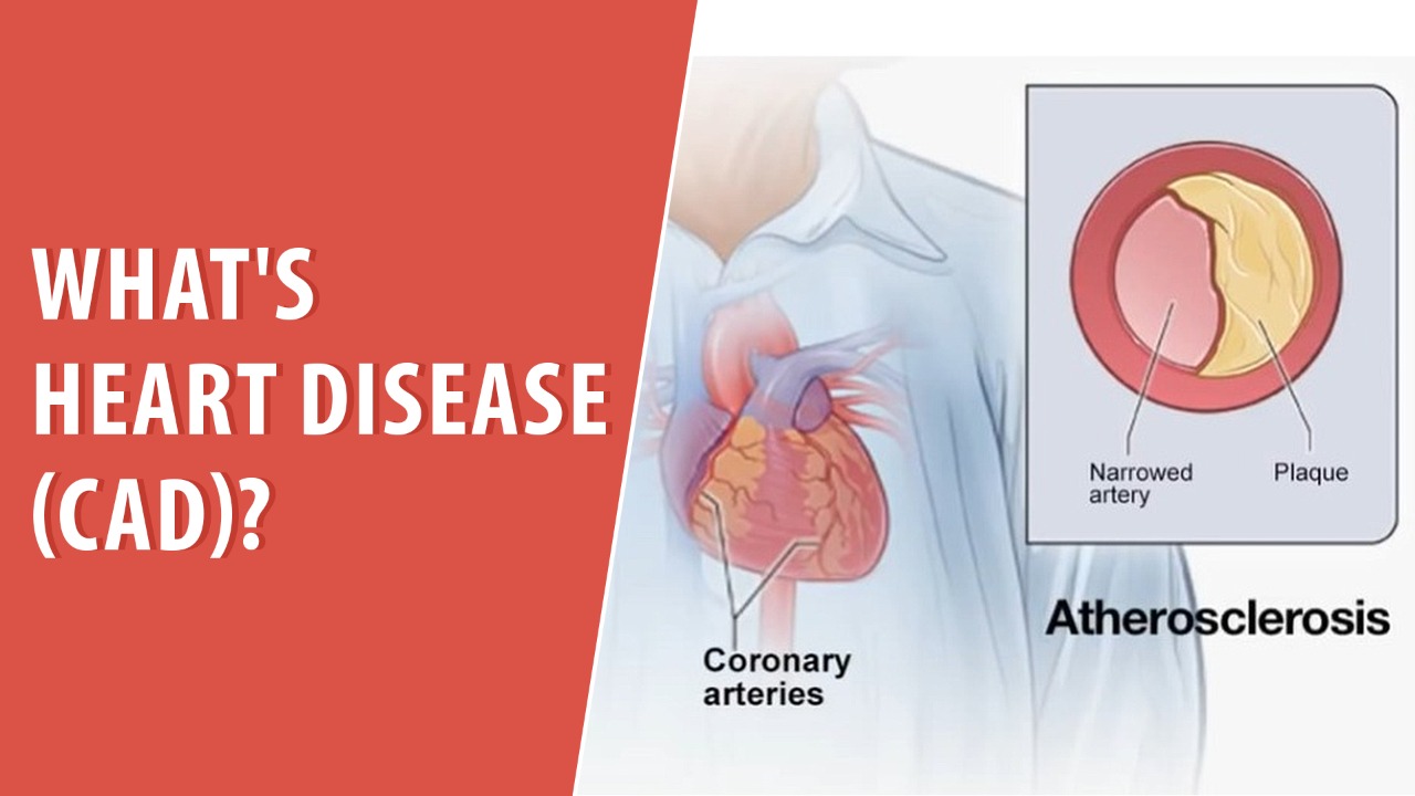 What's heart disease (CAD)?