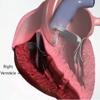 How Heart failure causes fluid build up