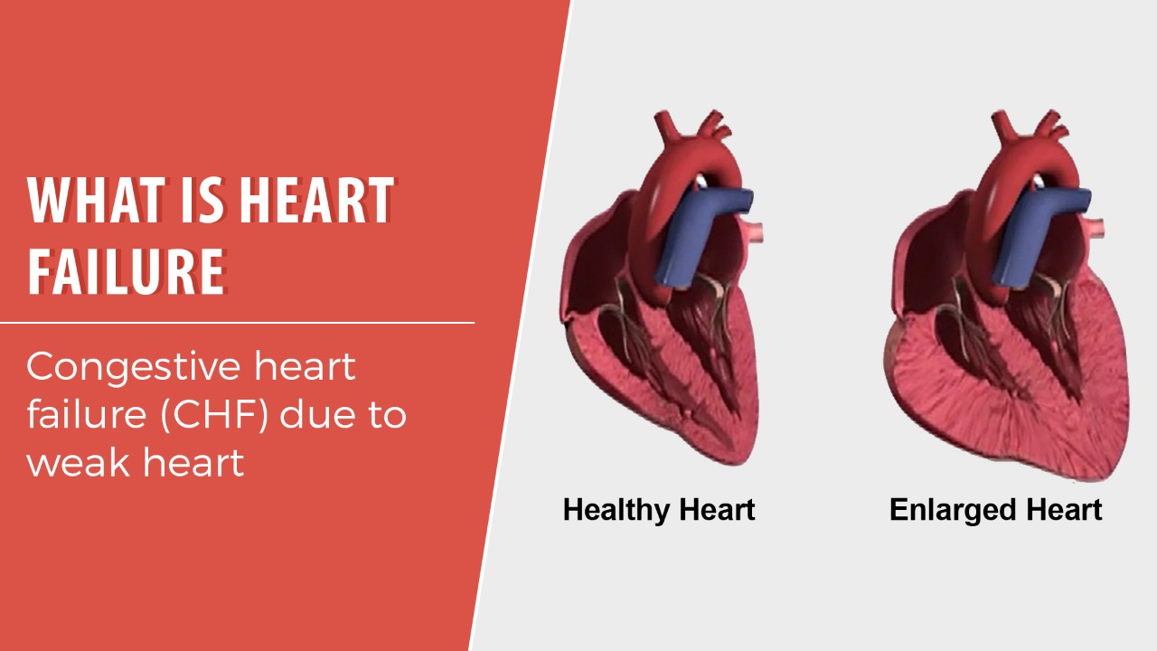 What Is Heart Failure