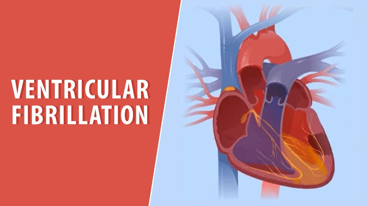 Ventricular fibrillation
