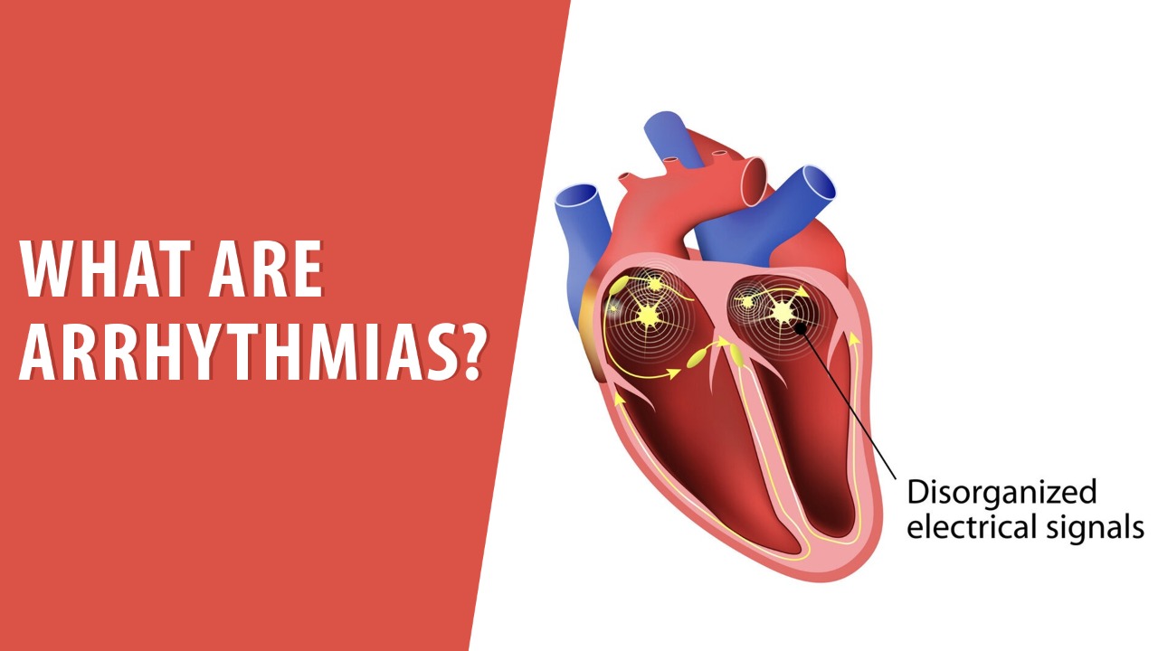 What are Arrhythmias?
