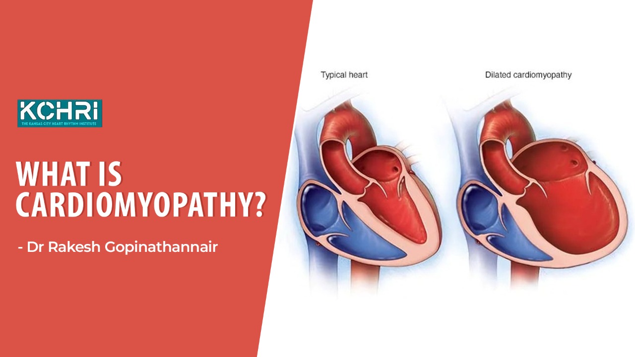 What is a Cardiomyopathy?