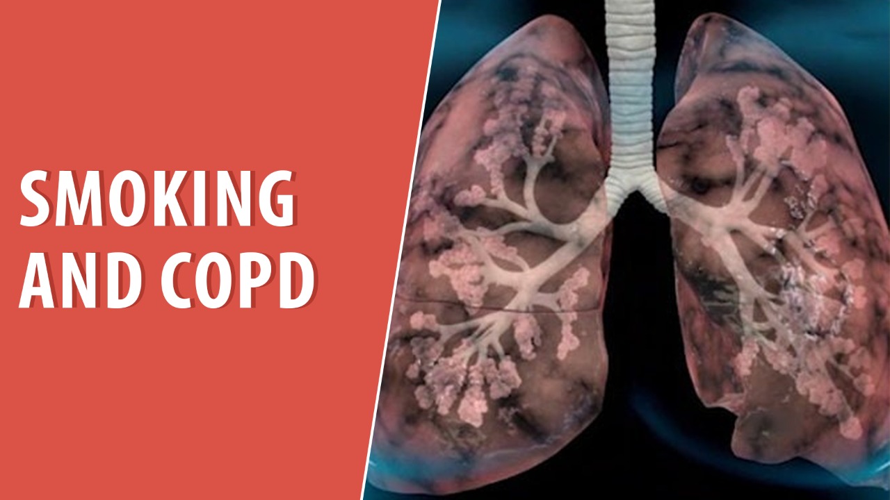 Smoking And COPD