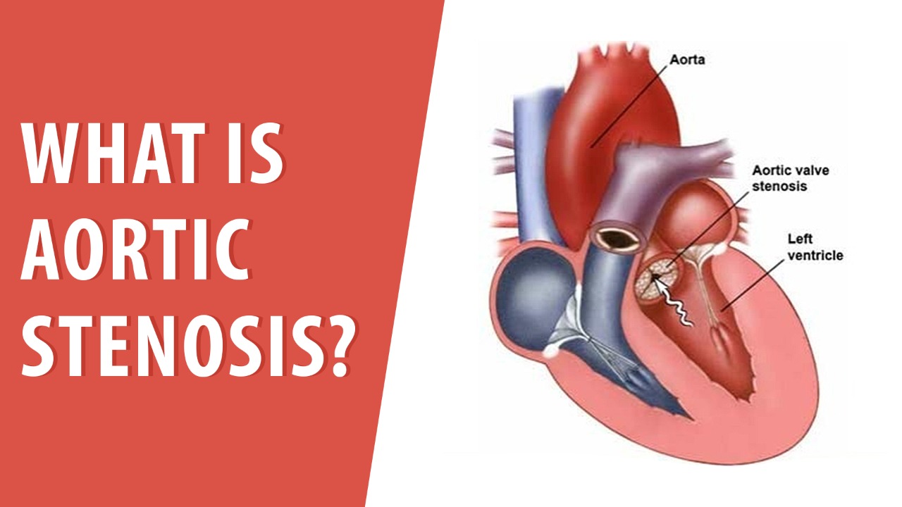 What Is Aortic Stenosis