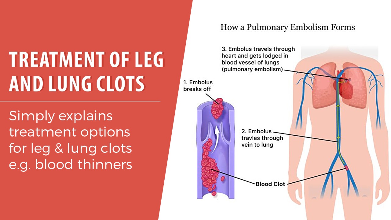 Treatment of leg and lung clots