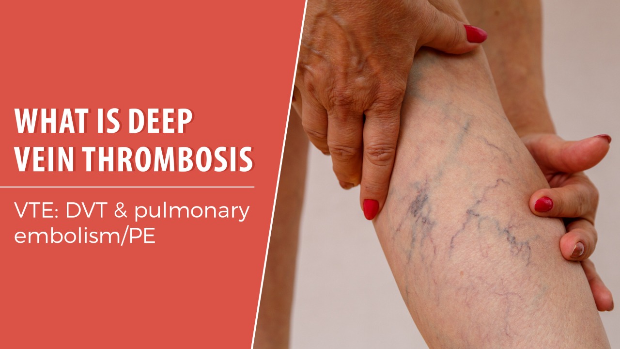 What's deep vein thrombosis