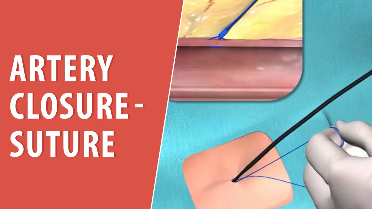 Artery Closure-Suture