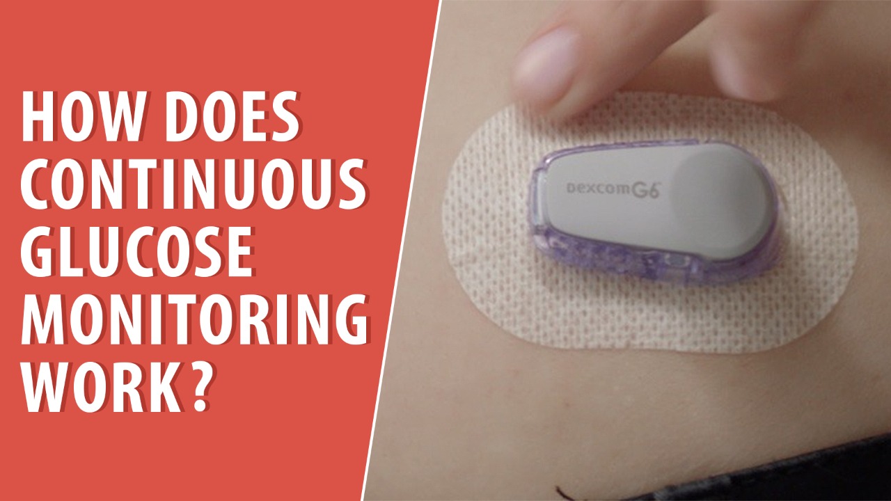 How Does Continuous Glucose Monitoring Work?