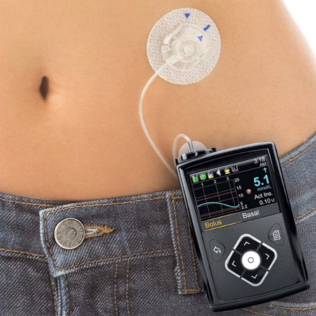 Insulin Pumps