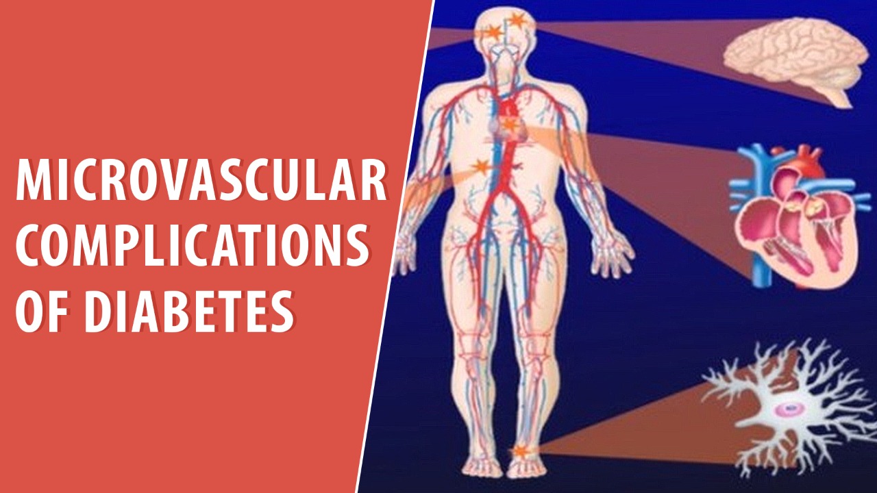 Microvascular Complications of Diabetes