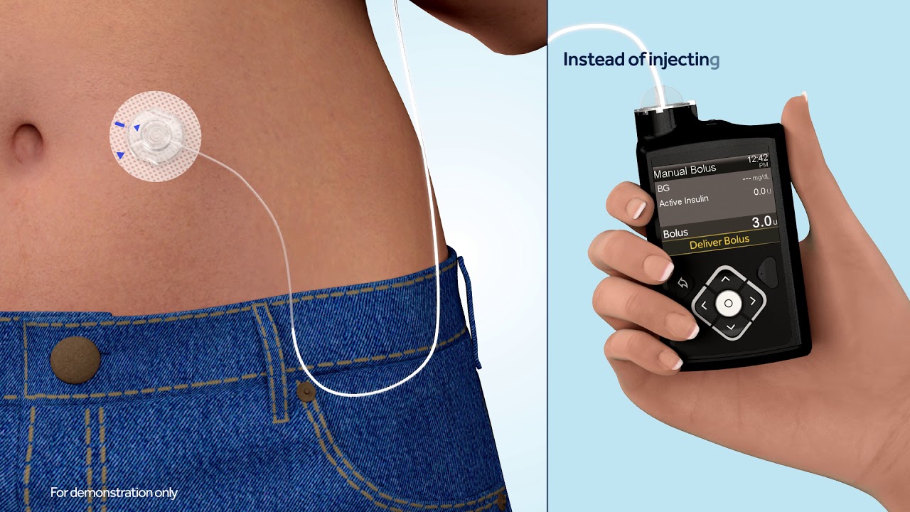 What Is An Insulin Pump