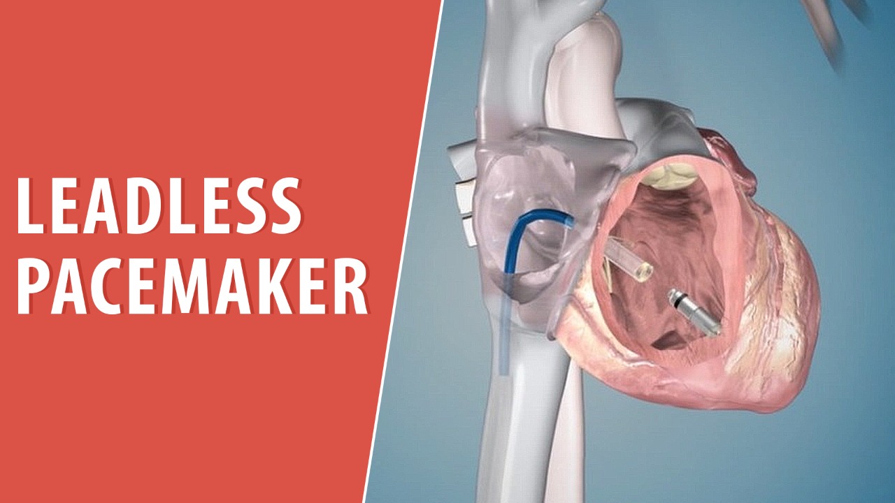 leadless-pacemaker