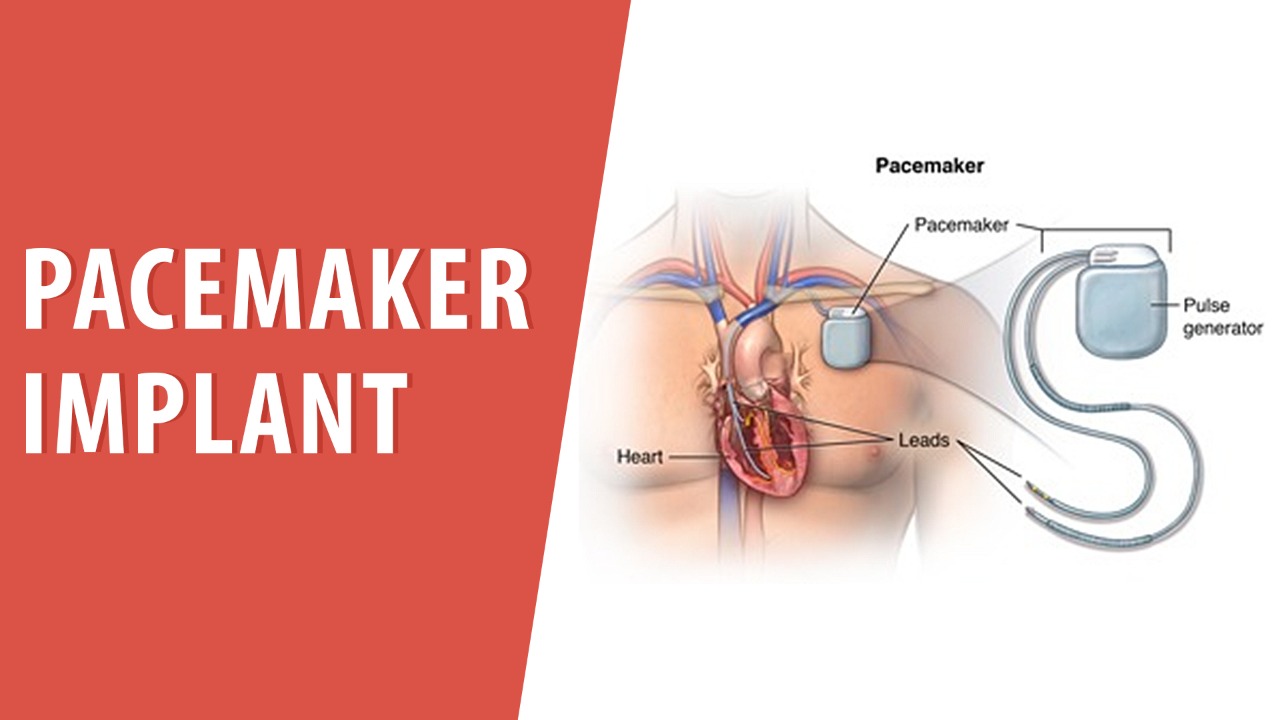 Pacemaker implant