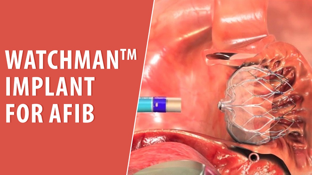 Watchman™Implant for AFib