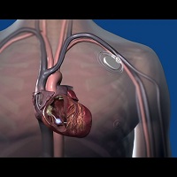 Pacemaker implant