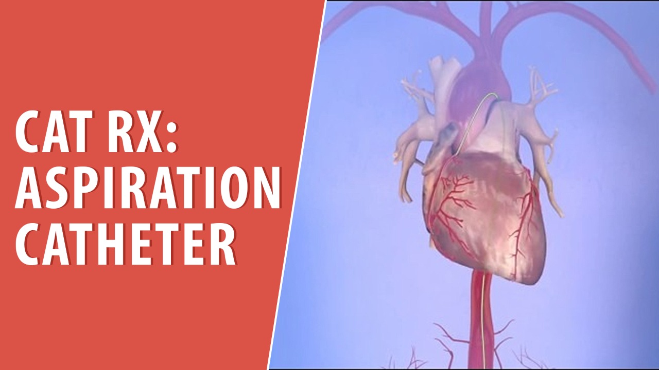 CAT RX: Aspiration Catheter