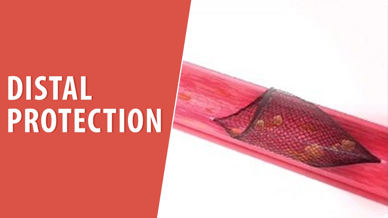 Distal protection 