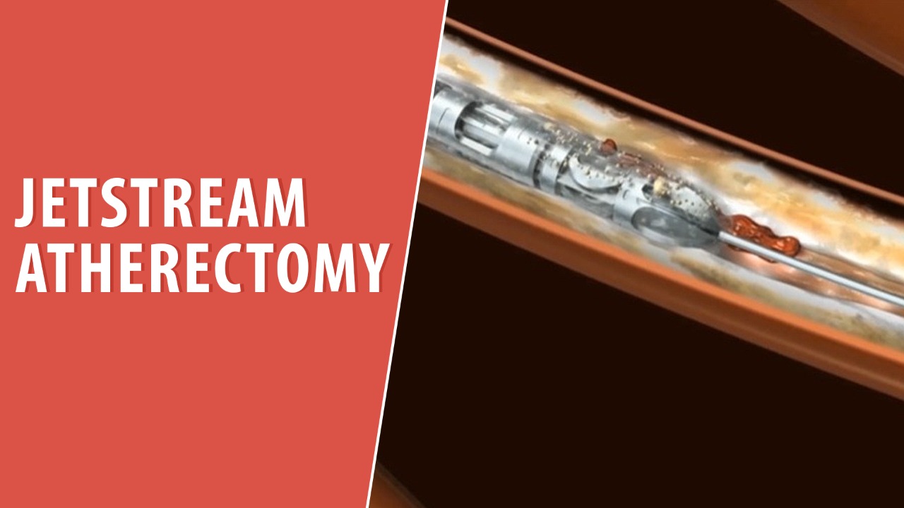 JetStream atherectomy