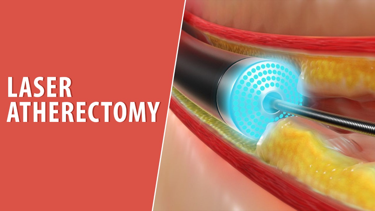 Laser atherectomy