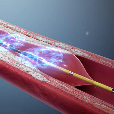 intravascular lithotripsy icd 10 pcs