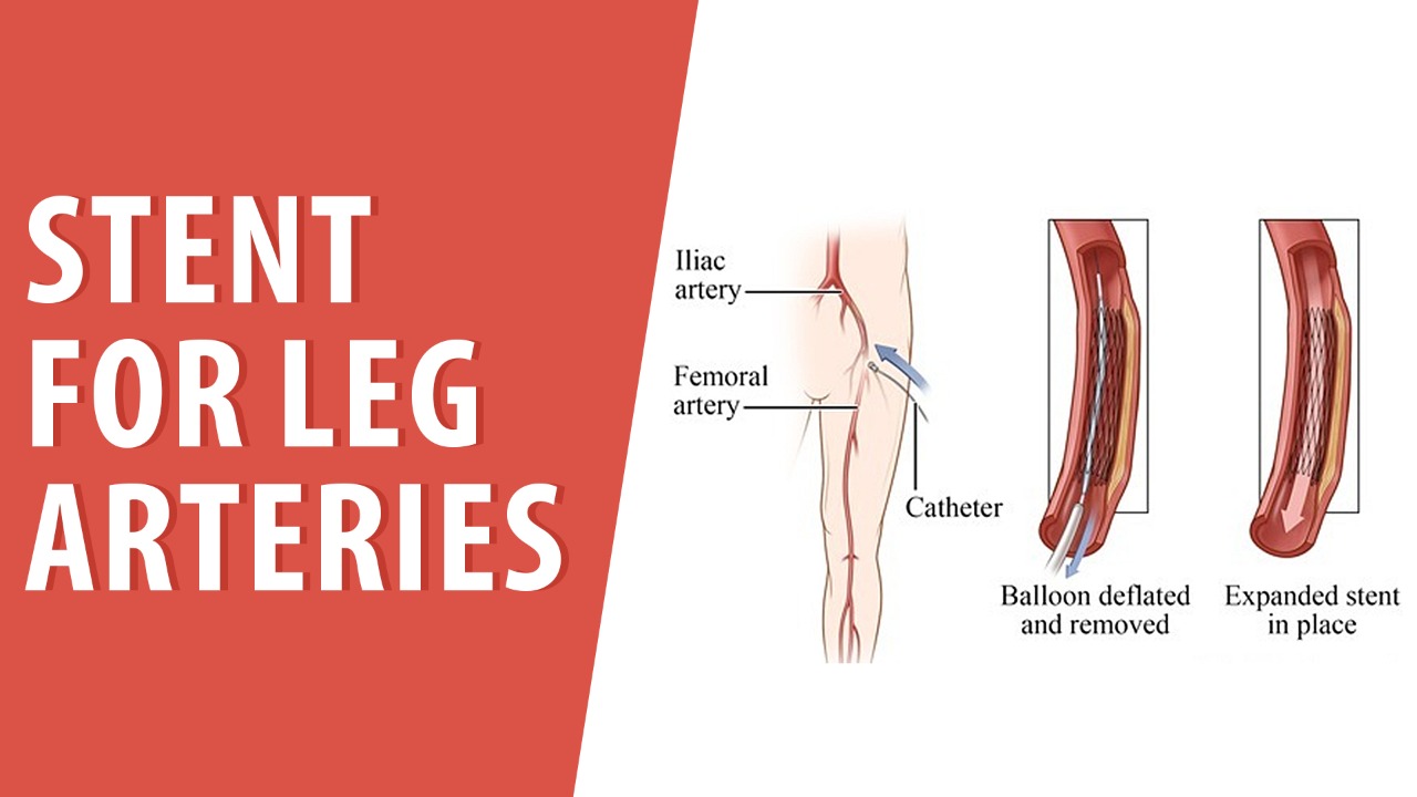 Stent for leg arteries