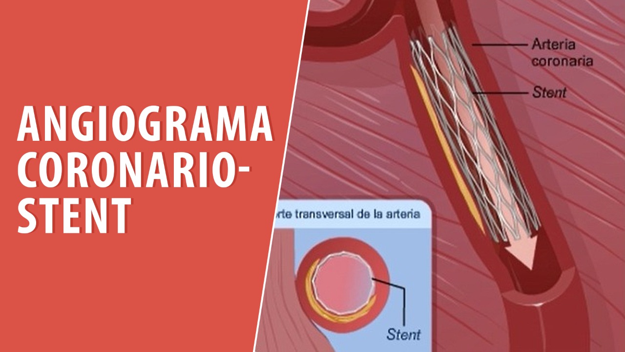 Angiograma Coronario-Stent