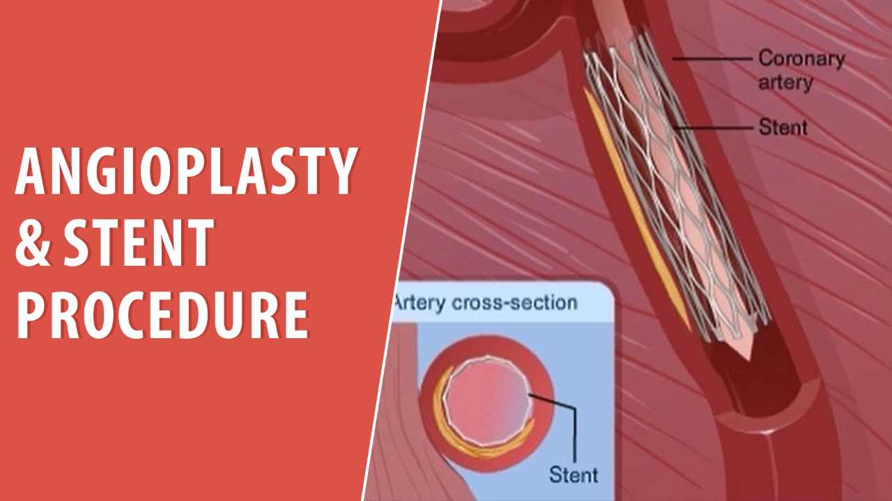 Angioplasty & Stent Procedure