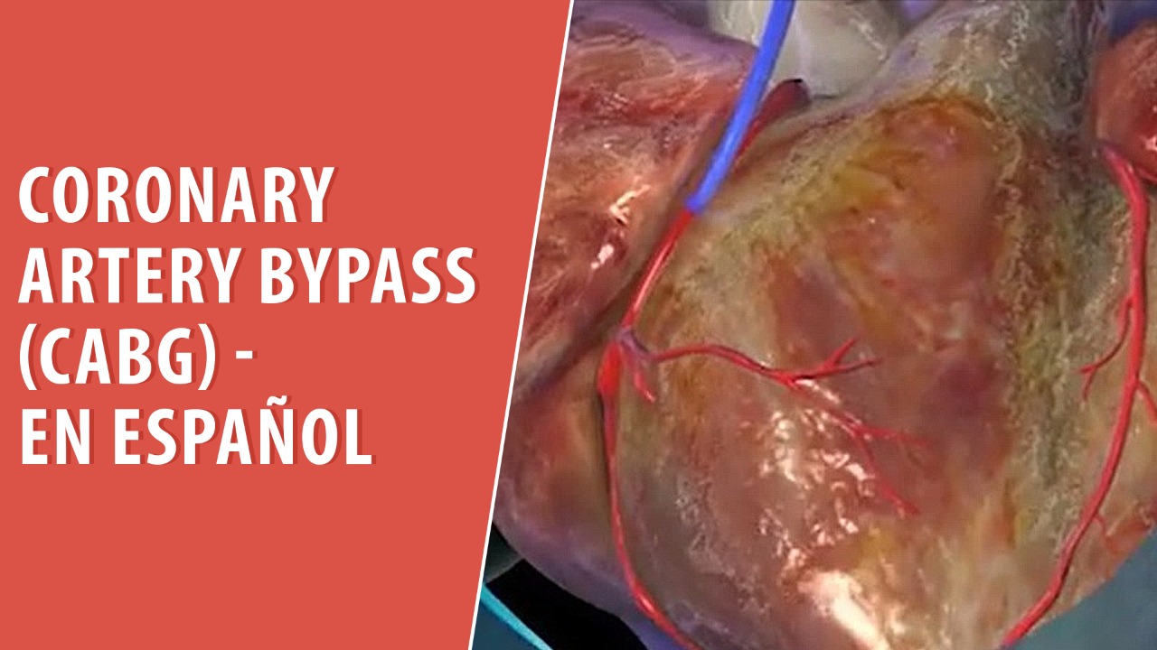 Coronary Artery Bypass (CABG) - Spanish