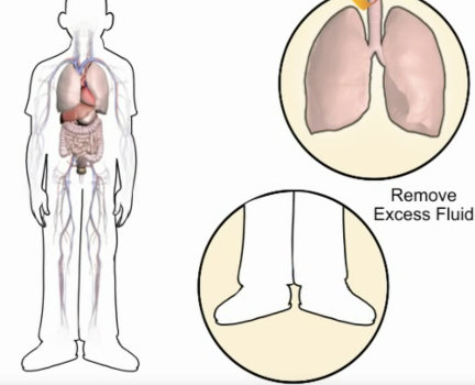 How Heart failure causes fluid build up
