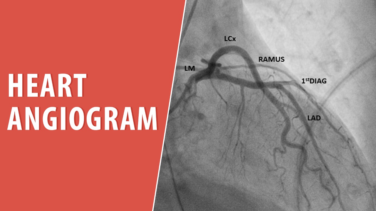 Heart Angiogram