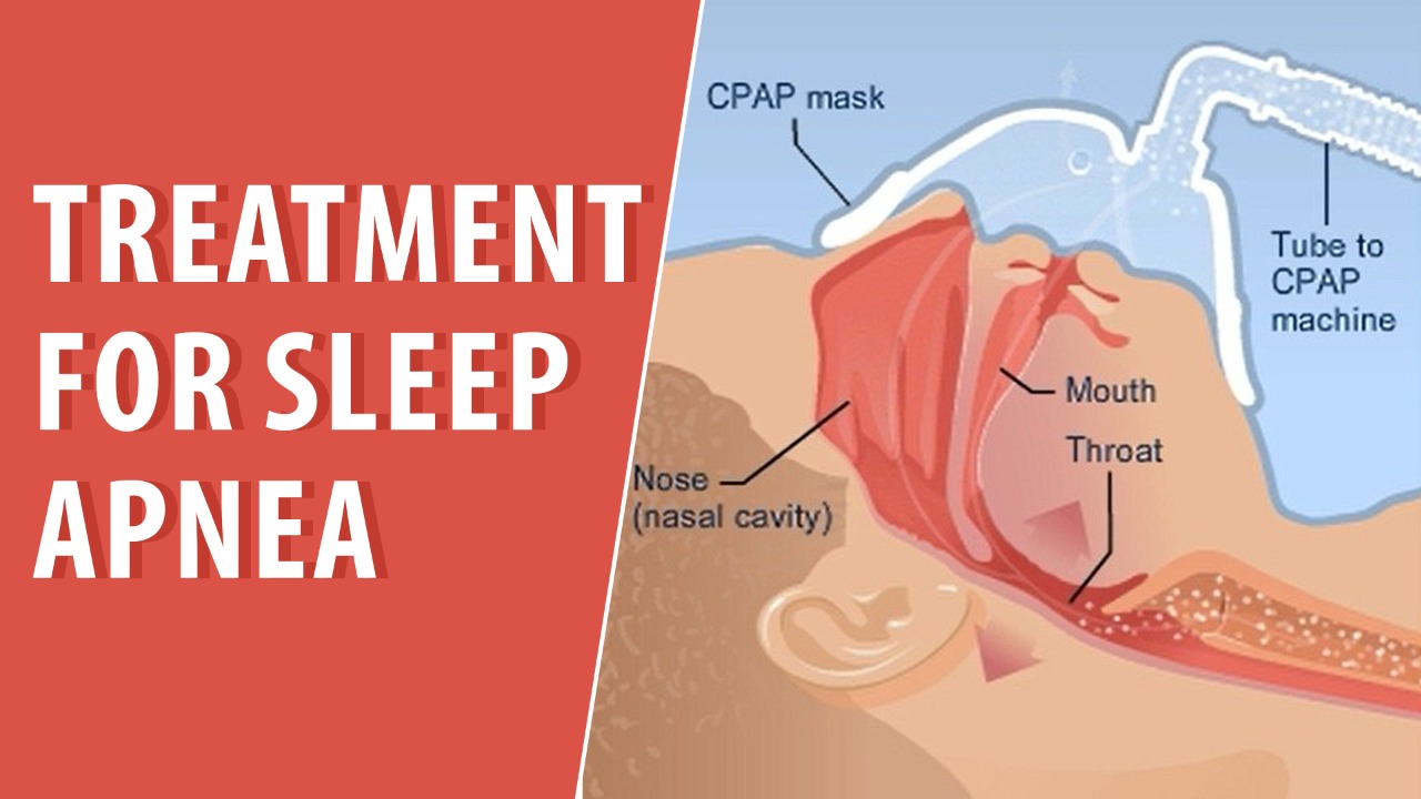 Treatment for sleep apnea