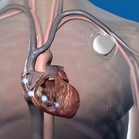 Pacemaker Implant