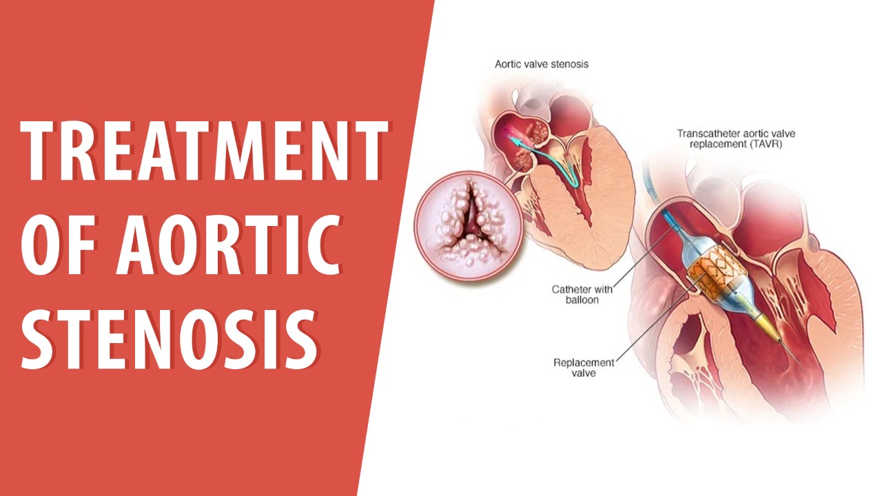 Treatment of Aortic Stenosis