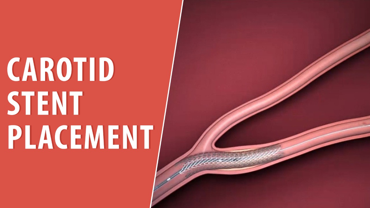 Carotid stent placement