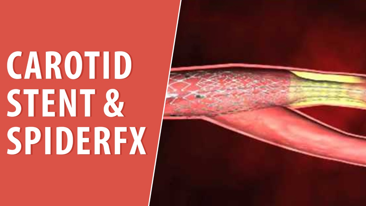 Carotid stent & Filter