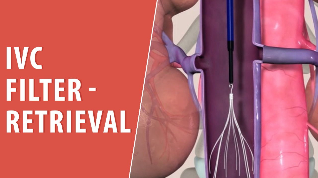Ivc Filter Definition Inferior Vena Cava IVC Filter Placement KKBT Ivc Filter Definition Inferior Vena Cava IVC Filter Placement KKBT