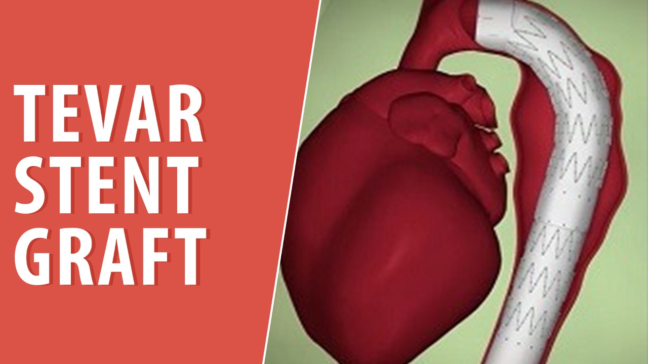 Thoracic Aneurysm Repair Thoracic Aneurysm Repair
