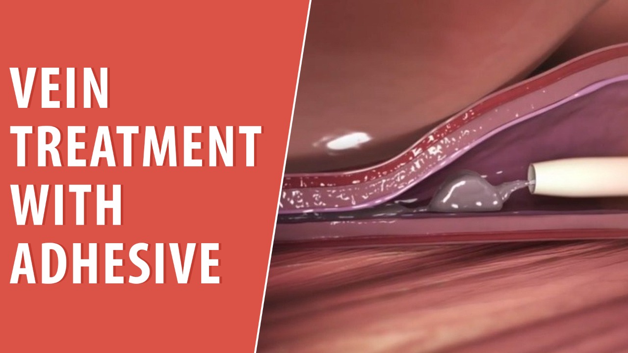 Vein Treatment with Adhesive